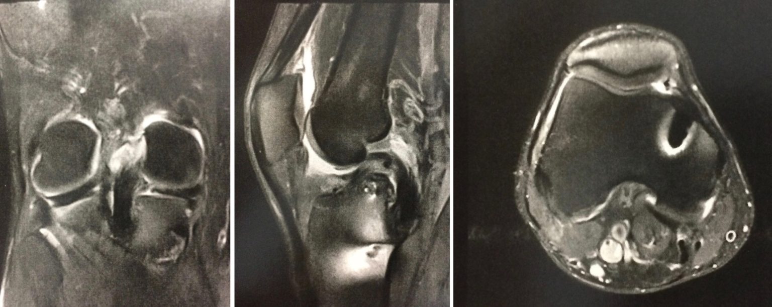 Chirurgie Du Ligament Crois Post Rieur Dr Yves Rouxel