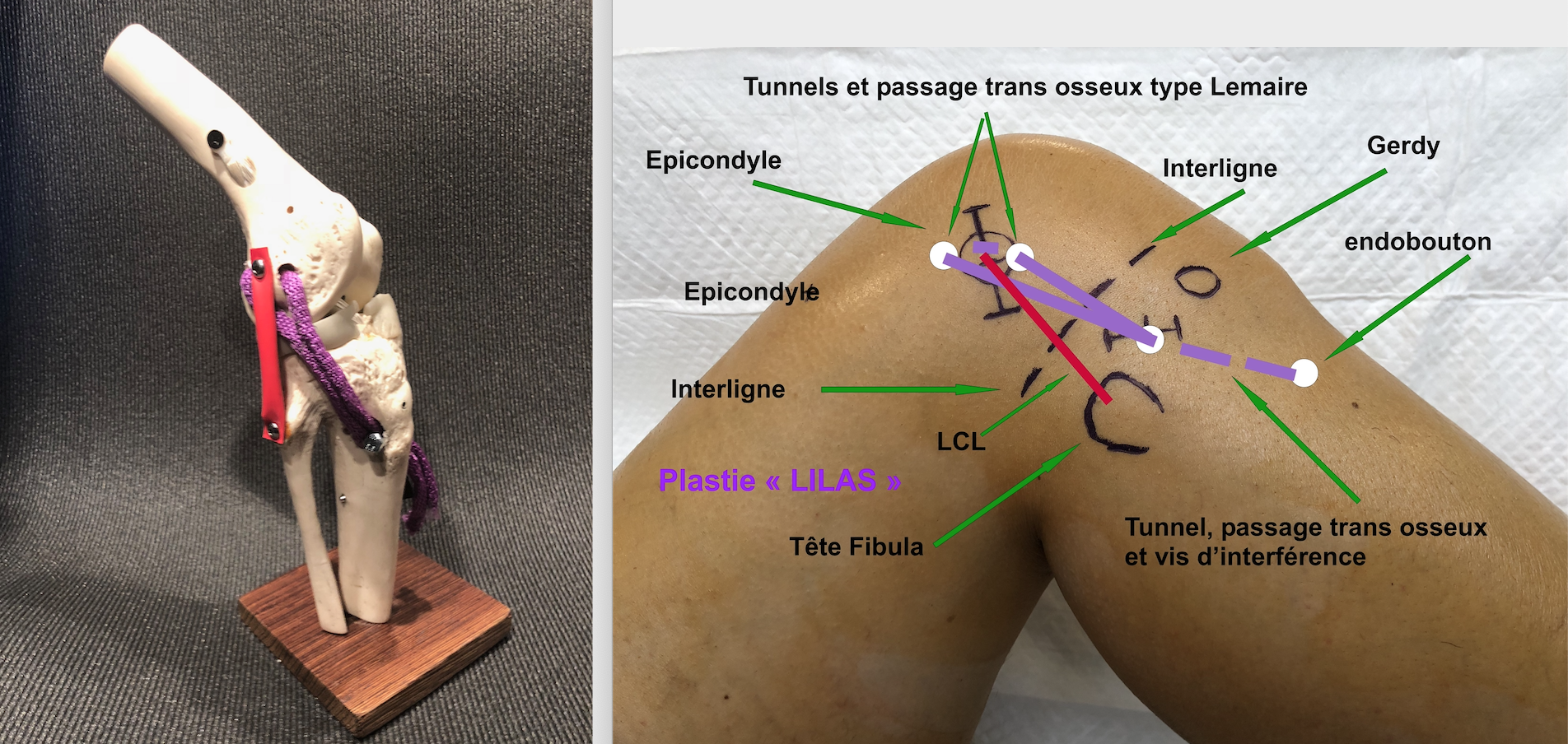 Arthrose et Prothèses de genou – Chirurgie Orthopédique & Sportive