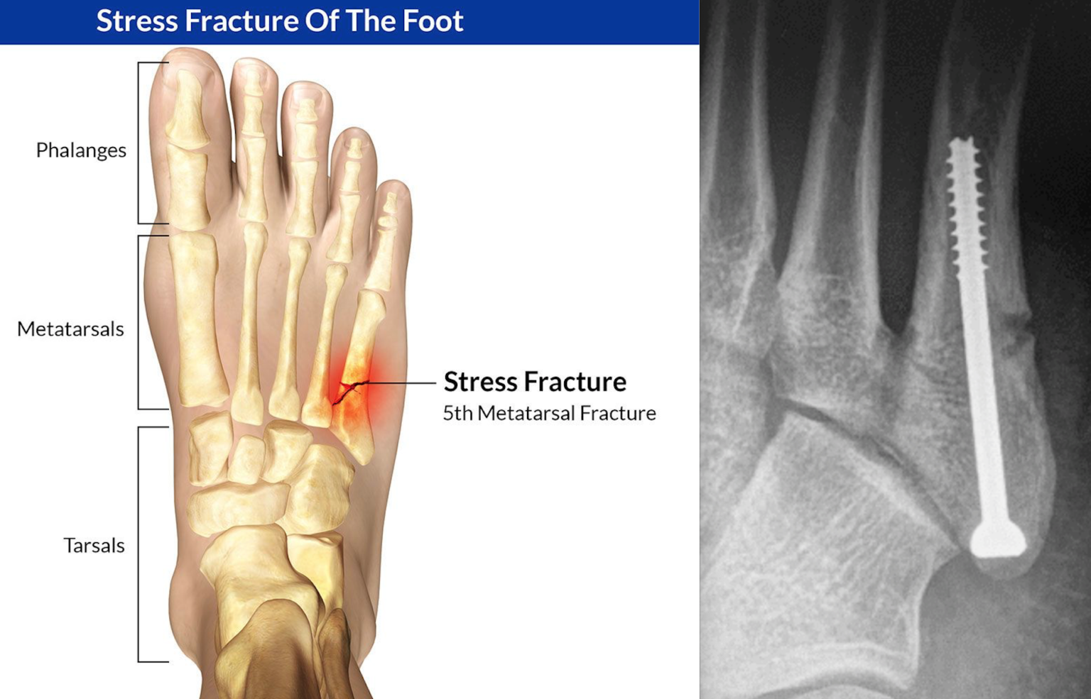 Fracture de fatigue Dr Yves ROUXEL